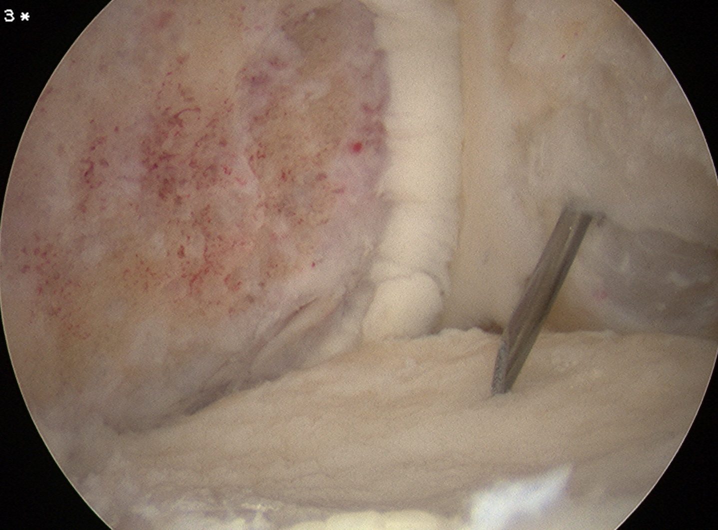 Knee OCD Case 11